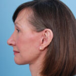 lower-facelift-after-4
