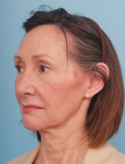 before lower facelift