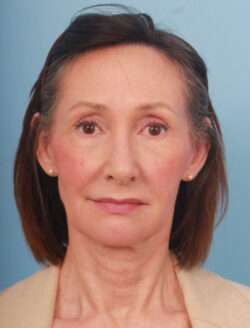 before lower facelift