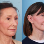 lower-facelift-merged-1