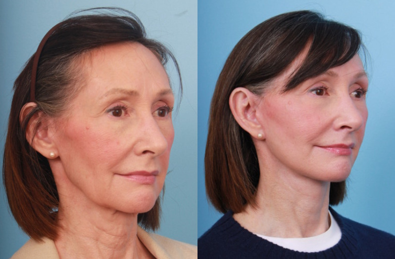 before_after_img