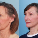 lower-facelift-merged-2