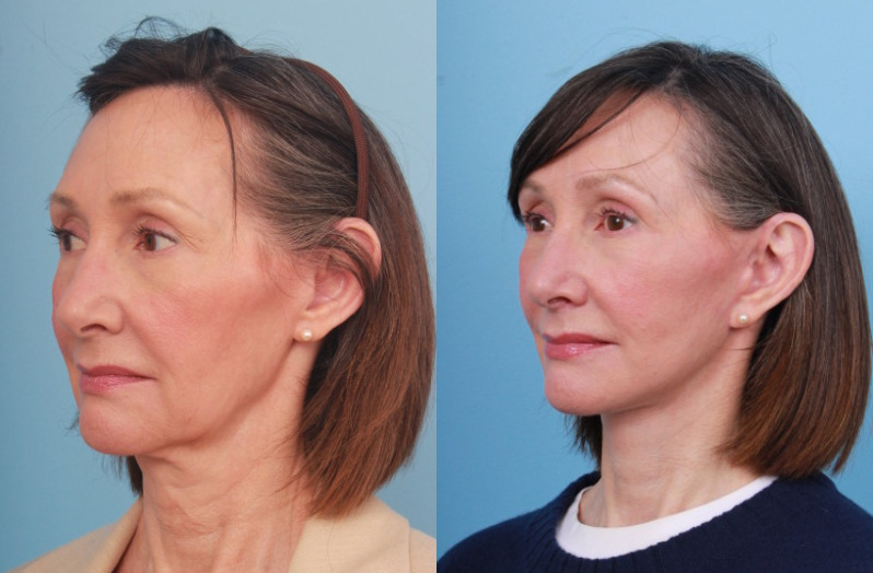 before_after_img