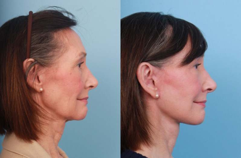 before_after_img