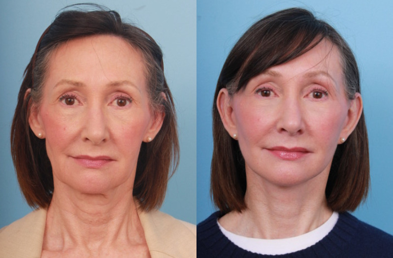 before_after_img