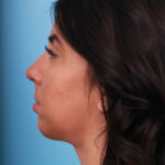 rhinoplasty-after-2