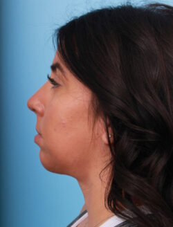 after rhinoplasty