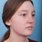 rhinoplasty-after-5