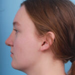 rhinoplasty-after-7