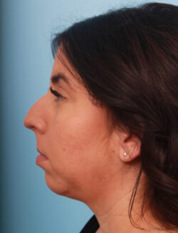 before rhinoplasty