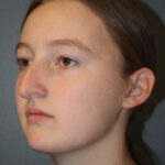 rhinoplasty-before-4
