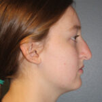 rhinoplasty-before-6