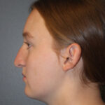 rhinoplasty-before-7