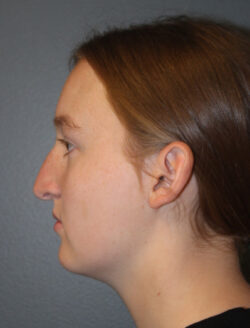 before rhinoplasty
