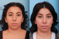 before and after rhinoplasty