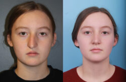 before and after rhinoplasty