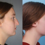 rhinoplasty-merged-6