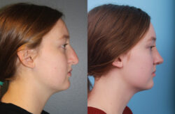 before and after rhinoplasty