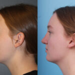 rhinoplasty-merged-7