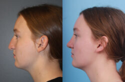 before and after rhinoplasty