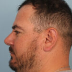 rhinoplasty-after-1