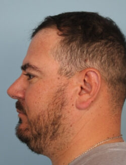 after rhinoplasty