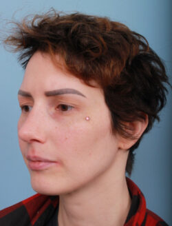 after rhinoplasty
