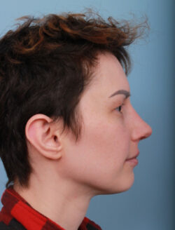 after rhinoplasty