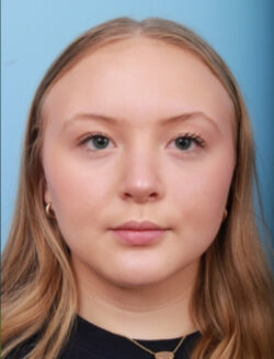 after rhinoplasty