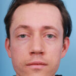 rhinoplasty-after-18
