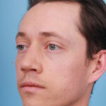 rhinoplasty-after-19