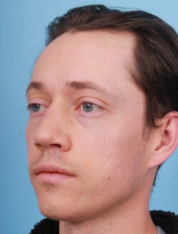 after rhinoplasty