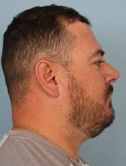 after rhinoplasty