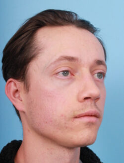 after rhinoplasty