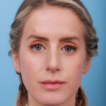 rhinoplasty-after-22