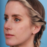 rhinoplasty-after-23