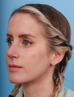after rhinoplasty