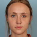 rhinoplasty-after-4