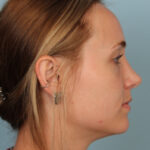rhinoplasty-after-7