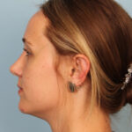 rhinoplasty-after-8