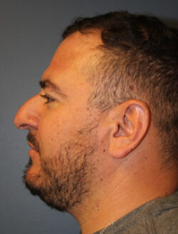 before rhinoplasty