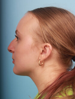 before rhinoplasty