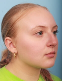 before rhinoplasty