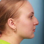 rhinoplasty-before-12