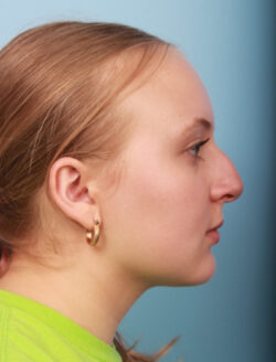 before rhinoplasty