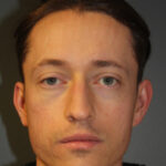 rhinoplasty-before-13