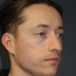 rhinoplasty-before-15