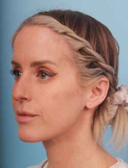 before rhinoplasty