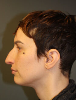 before rhinoplasty