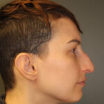 rhinoplasty-before-8